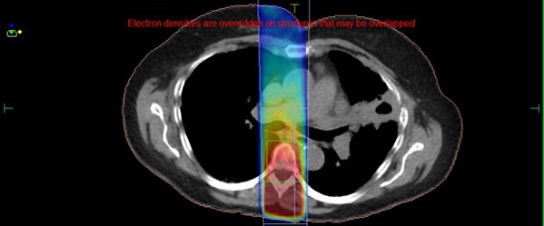 A scan image showing a single beam colour wash dose distribution for MR planned spinal cord treatment. Red text across the image reads 'Electron densities are overridden on structures that may be overlapped'.