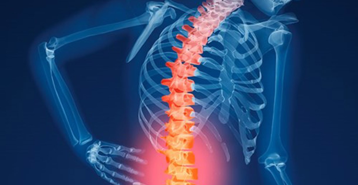 Osteoporosis and fracture risk