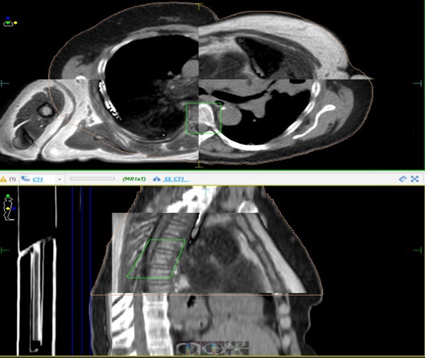 2 scan images showing thoracic spinal cord image matching CT–MR.